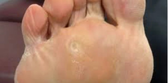 painful callus on bottom of heel