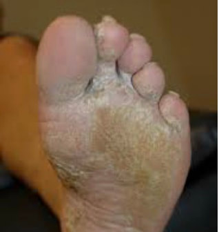 skin fissure ball of foot